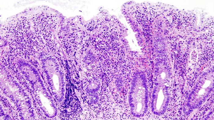 Ulcerative colitis endoscopic biopsy