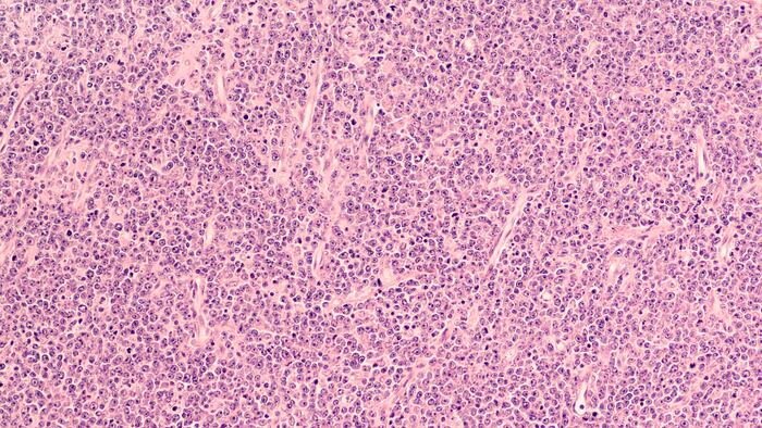 Lymphoma