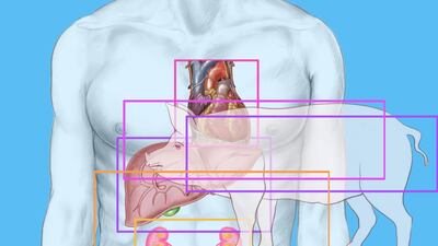 Pig Heart Xenotransplant Signals Future Solution To Donor Shortage