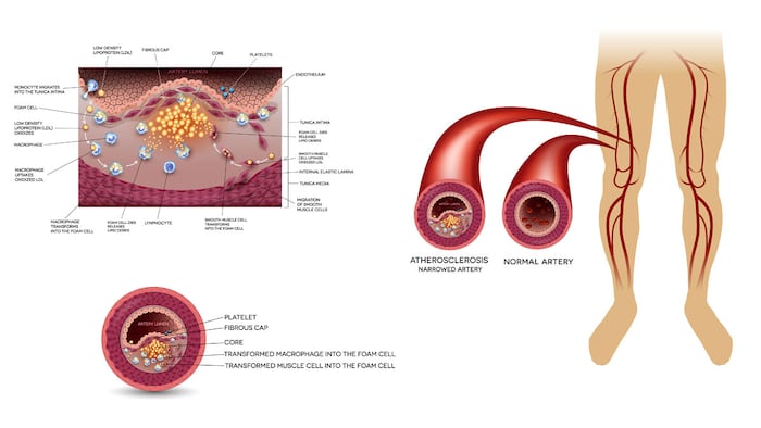Narrowed leg artery