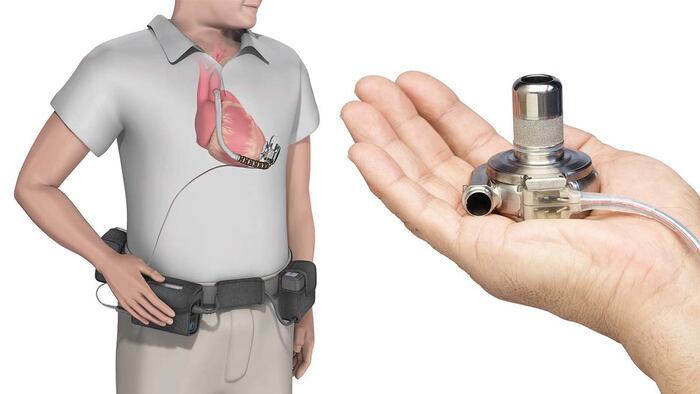 An illustration of Medtronic's HeartWare device being worn and a photo of the pump