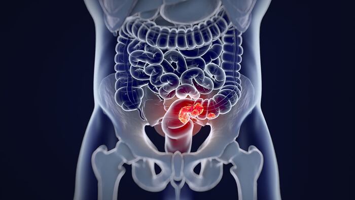 Colorectal cancer; medical anatomical illustration
