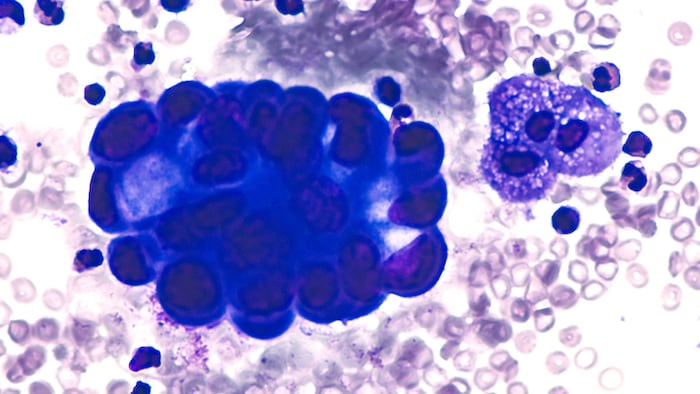 Malignant effusion: Pleural fluid cytology of lung (pulmonary) adenocarcinoma, a type of non small cell carcinoma.
