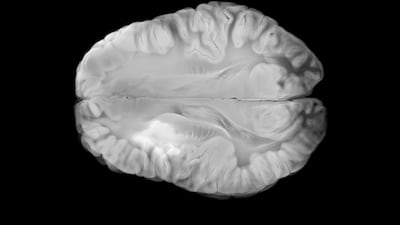 Route 92 To Drive FreeClimb Neurointervention Sales With Extended Series F Funding