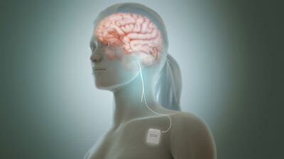 LivaNova Launches RECOVER Trial Of VNS For Depression To Meet CMS CED Requirement