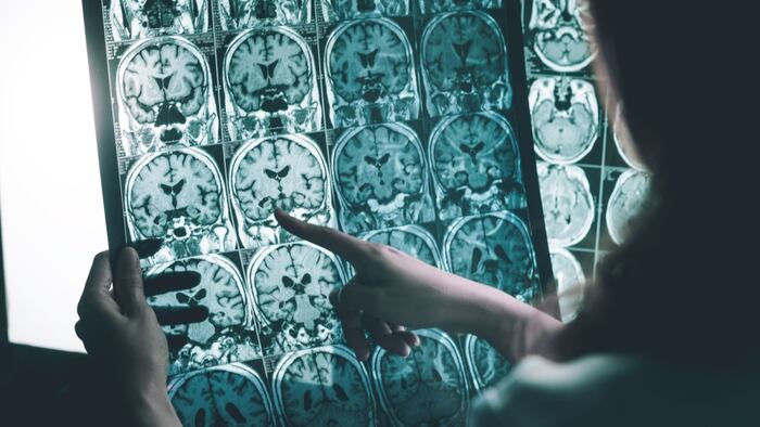 Alzheimers imaging