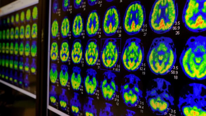 PET CT Scan