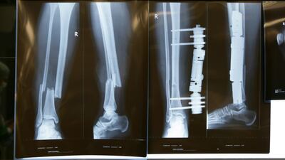 Fracture Fixation Devices Market Projected A Return To Steady Growth