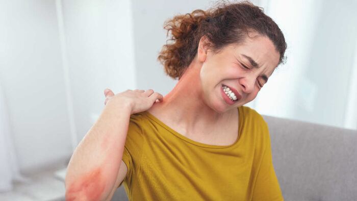 Atopic dermatitis