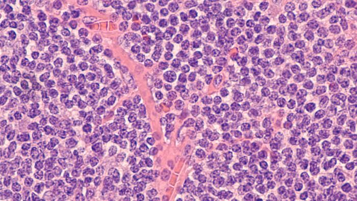 Lymphoma awareness: photomicrograph of a mantle cell lymphoma, a type of non-Hodgkin B-cell lymphoma.