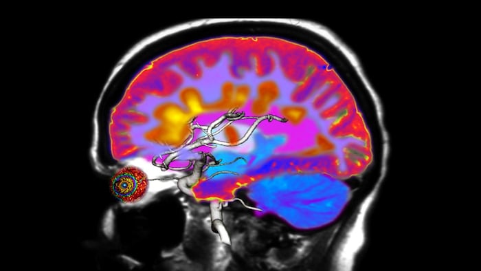 Brain with MS