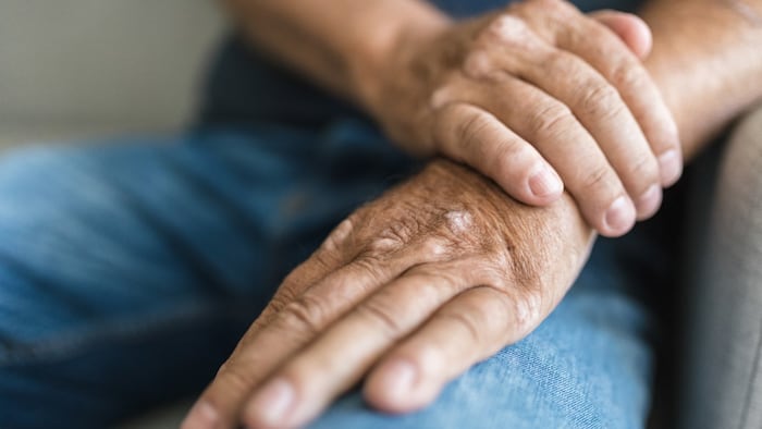Elderly man suffering from psoriasis, closeup on hands