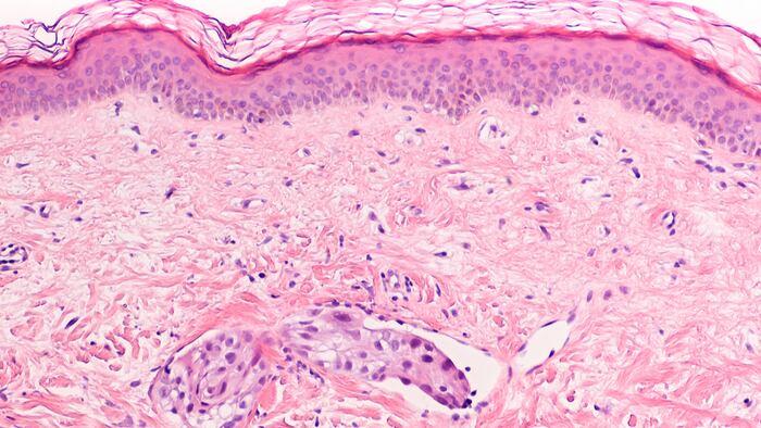 Breast carcinoma