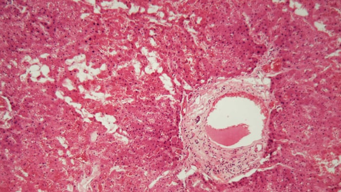 Amyloidosis