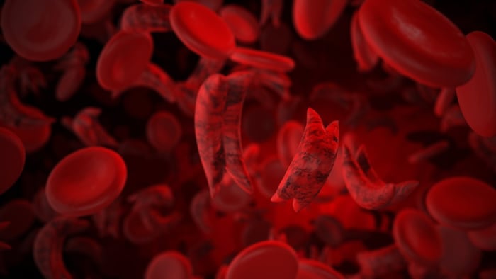 sickle cell disease