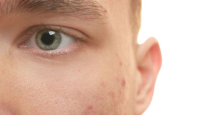 Acne on face