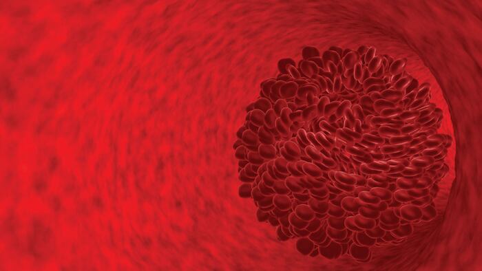 blood clot