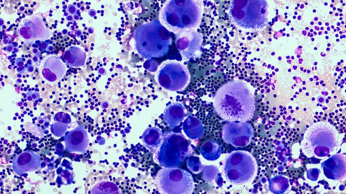 Adenocarcinoma