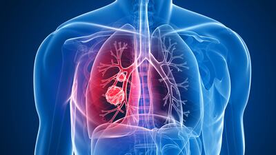 ESMO 23: Non-Squamous NSCLC Population Props Up Dato-DXd In TROPION-Lung01