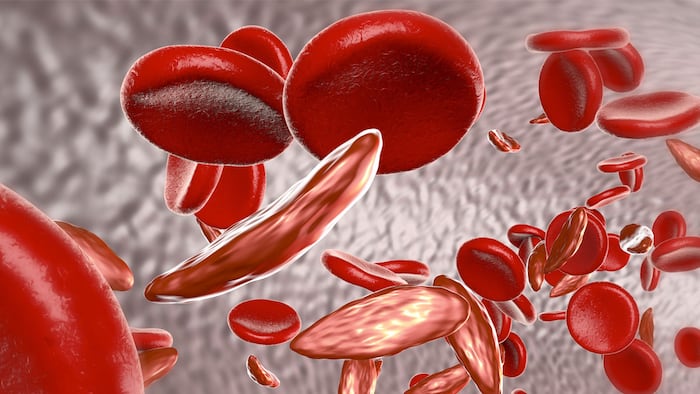 Sickle cell anemia, 3D illustration showing blood vessel with normal and deformated crescent-like red blood cells