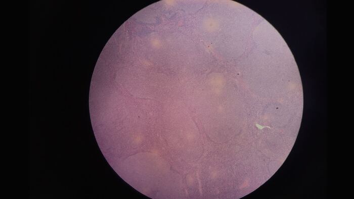 Follicular lymphoma is one of mature B-cell neoplasm