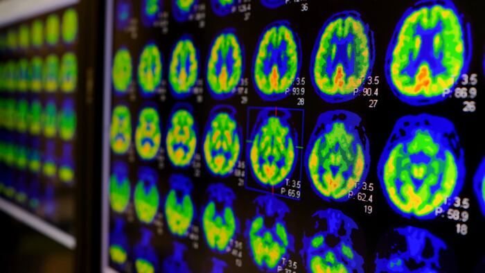 PET CT scan of Human Brain (Axial view Positron Emission Tomography)
