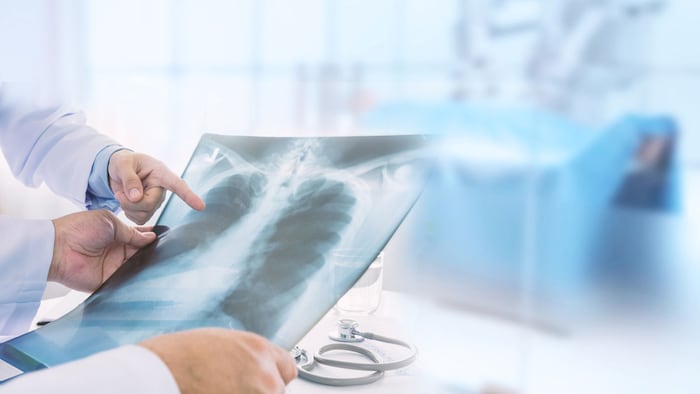 Doctor examining at lungs radiograph x-ray film of patient in operation room. medical concept.