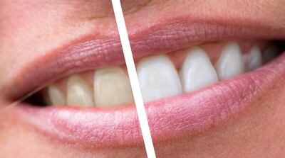 Colgate, P&G Extend Teeth Whitening Lines