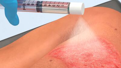 Avita’s Recell Heals 98% Of Burns In Pediatric Trial