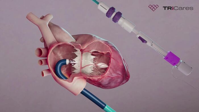 Topaz transfemoral tricuspid heart valve replacement system