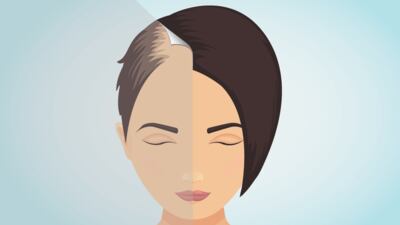 Soterios Topical Could Take On JAK Class In Alopecia Areata