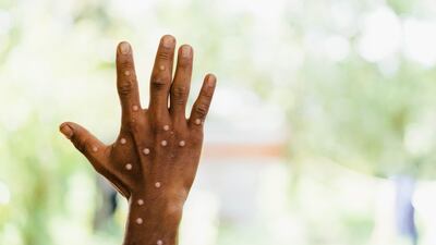 Tonix Sees Mpox Vaccine Opportunity As A Potential Lifeline