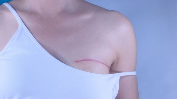 close up of person with breast surgery scar